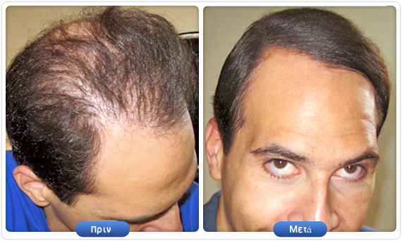 Μαρτυρία DermMatch με αποτέλεσμα πριν και μετά σε άνδρα με αραίωση μαλλιών και ορατό τριχωτό της κεφαλής